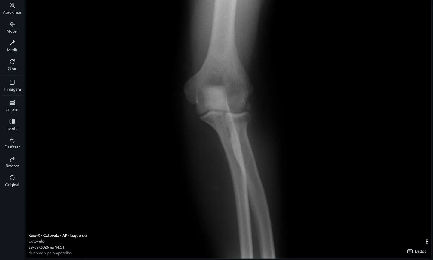 Visualizador do VenaPACS com uma radiografia de cotovelo e a barra de ferramentas com nome à esquerda.